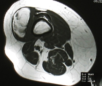 Lipoma MRI 2